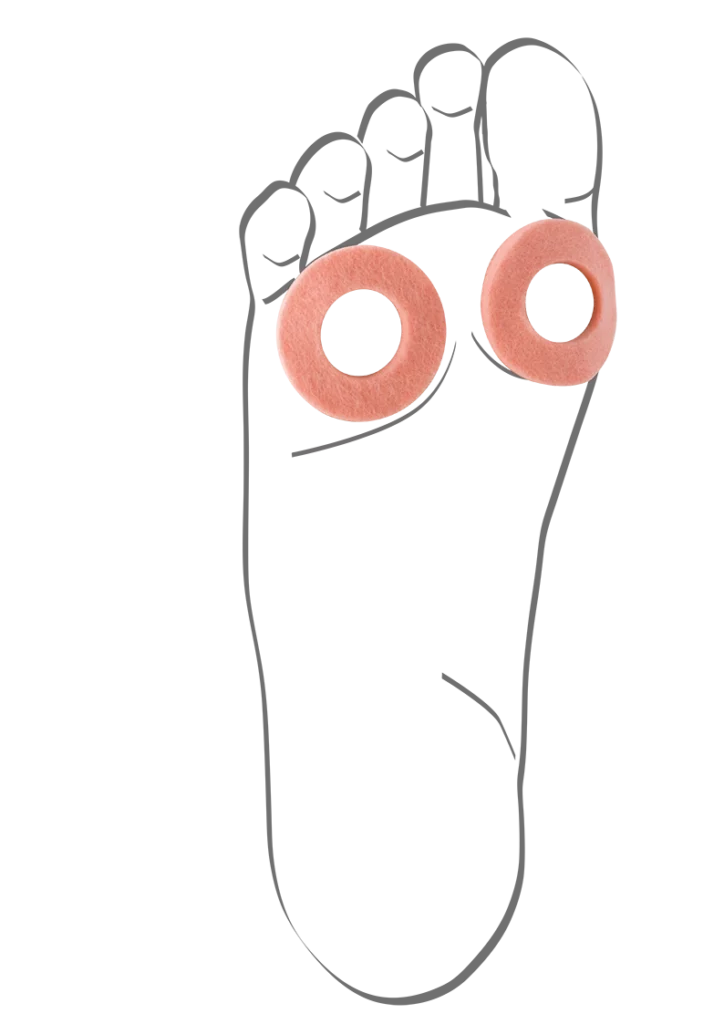 Abbildung einer Fußskizze mit zwei aufgeklebten Hornhaut-Schutzringen im Vorfußbereich. Die weichen, hautfarbenen Filzringe entlasten gezielt druckempfindliche Stellen, schützen vor Reibung und lindern Schmerzen bei Hühneraugen oder Schwielen.