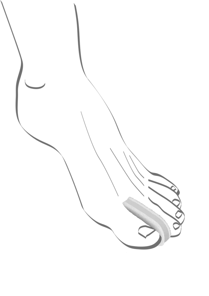 Abbildung einer Fußskizze mit einem Zehenspreizer zwischen der ersten und zweiten Zehe. Der weiche Schaumstoffspreizer trennt die Zehen sanft, verhindert Reibung und Druckstellen und unterstützt die natürliche Zehenstellung – ideal bei Hallux valgus oder eng anliegenden Zehen.