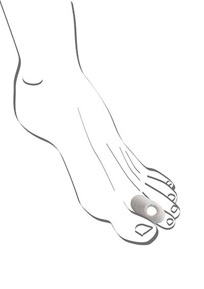 Abbildung einer Fußskizze mit Hammerzehen-Schutzpflaster von Berkemann. Das weiche, weiße Polster liegt auf dem mittleren Zehengelenk und hat eine Öffnung zur gezielten Druckentlastung. Es schützt vor Reibung und Druckstellen bei Hammer- oder Krallenzehen.